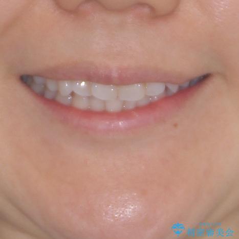 長年気にしていた前歯 インビザラインで目立たず改善の治療前(顔貌)