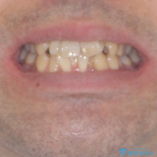 ものが挟まる 著しい叢生を解消 ワイヤー装置による抜歯矯正の治療前(顔貌)