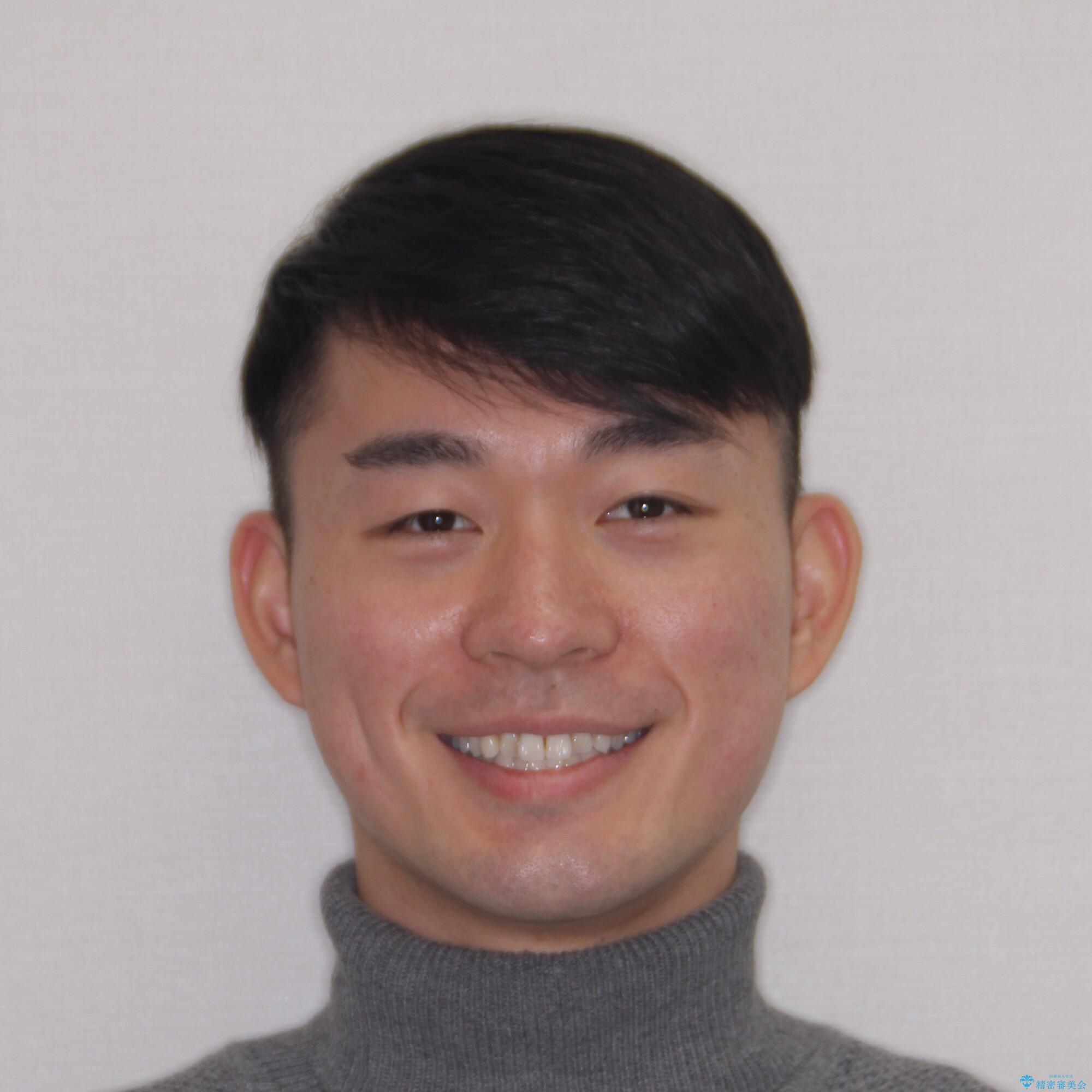 【モニター】 インビザライン・ライトによる軽微叢生の矯正治療の治療前(顔貌)