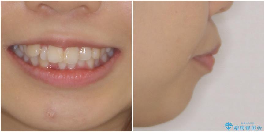 口元の突出感を改善 2年弱での抜歯矯正の治療前(顔貌)