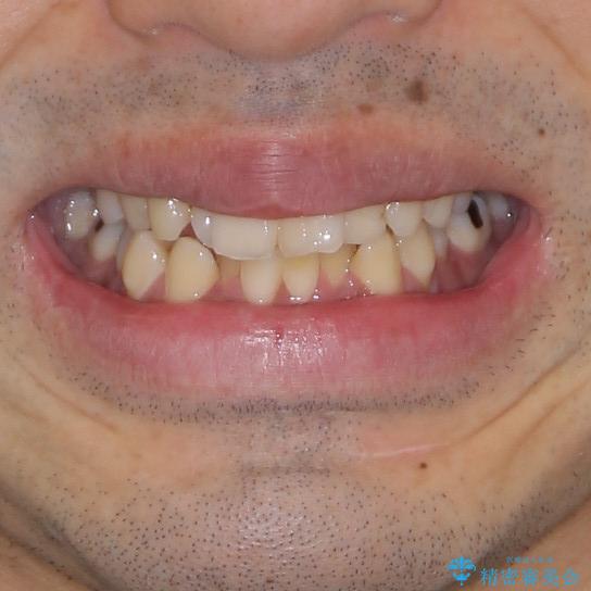 下顎骨が顕著に右側にずれている インビザラインによる咬合改善の治療前(顔貌)