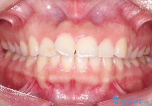 【インビザライン】前歯が出ているのを治したいの治療前