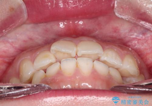 【インビザライン】前歯が出ているのを治したいの治療前