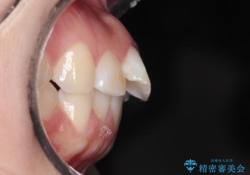 【インビザライン】前歯が出ているのを治したいの治療前