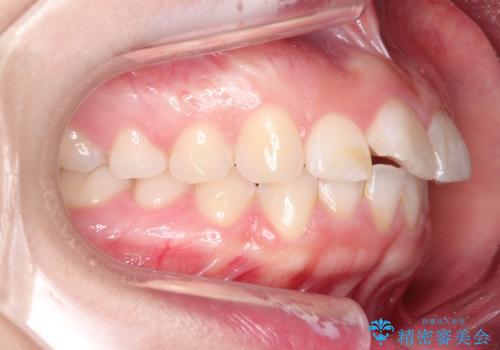 【インビザライン】前歯が出ているのを治したいの治療前