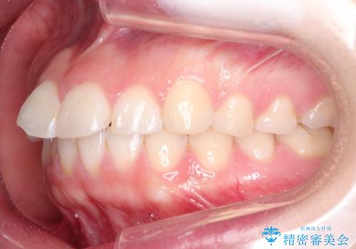 【インビザライン】前歯が出ているのを治したいの治療前