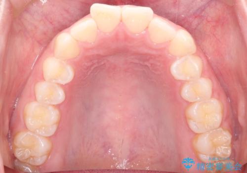 【インビザライン】前歯が出ているのを治したいの治療前