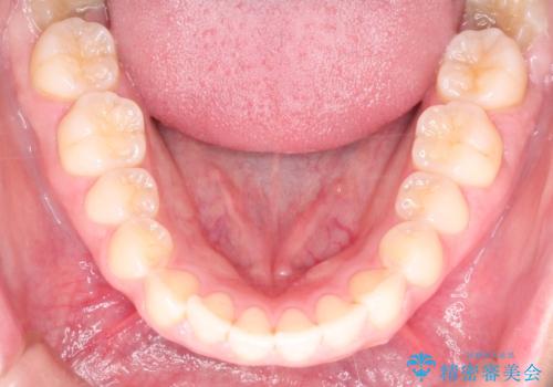 【インビザライン】前歯が出ているのを治したいの治療前