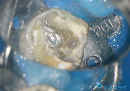 【外部吸収】根管治療、外科治療からのオールセラミッククラウンの治療前