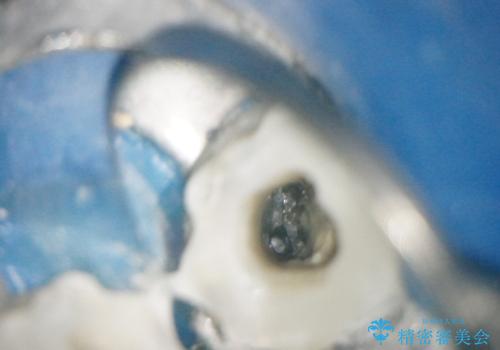 【外部吸収】根管治療、外科治療からのオールセラミッククラウンの治療中