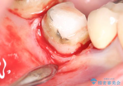 【外部吸収】根管治療、外科治療からのオールセラミッククラウンの治療前