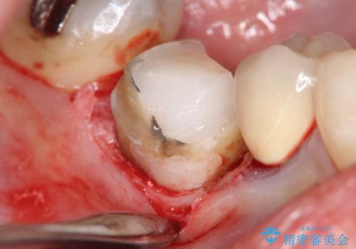 【外部吸収】根管治療、外科治療からのオールセラミッククラウン