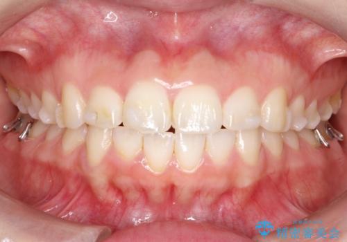 【インビザライン】前歯が出ているのを治したいの治療中