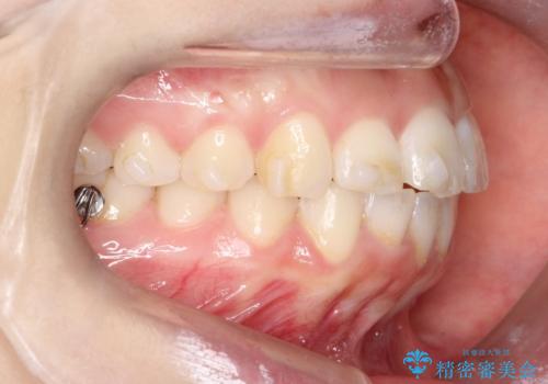 【インビザライン】前歯が出ているのを治したいの治療中