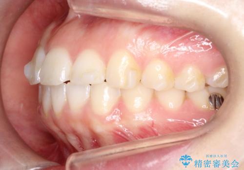 【インビザライン】前歯が出ているのを治したいの治療中