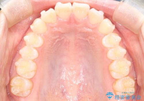 【インビザライン】前歯が出ているのを治したいの治療中