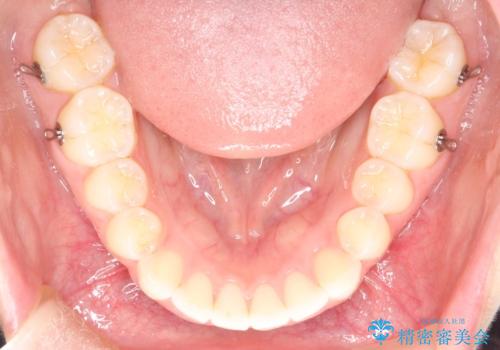 【インビザライン】前歯が出ているのを治したいの治療中