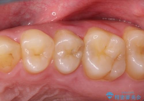 根管治療〜オールセラミッククラウンの治療前