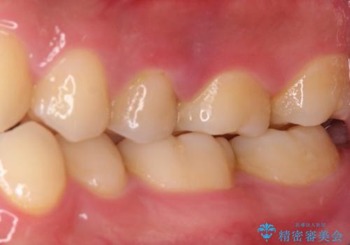 根管治療〜オールセラミッククラウンの治療前