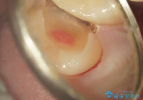 根管治療〜オールセラミッククラウンの治療中