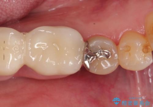 【PGAインレー】深い位置の二次カリエスの治療前