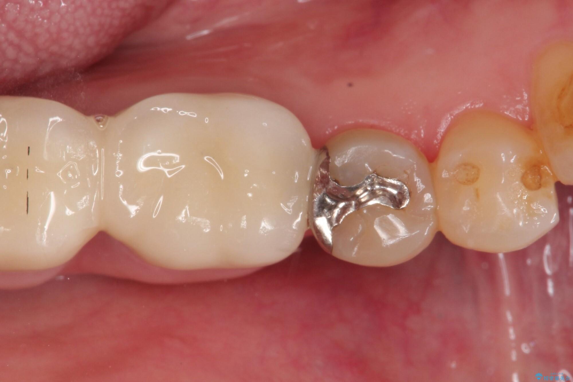 【PGAインレー】深い位置の二次カリエス|(医)精密審美会 【PGAインレー】深い位置の二次カリエス|(医)精密審美会