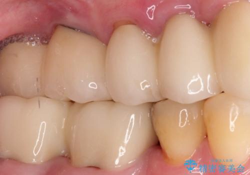【PGAインレー】深い位置の二次カリエスの治療前
