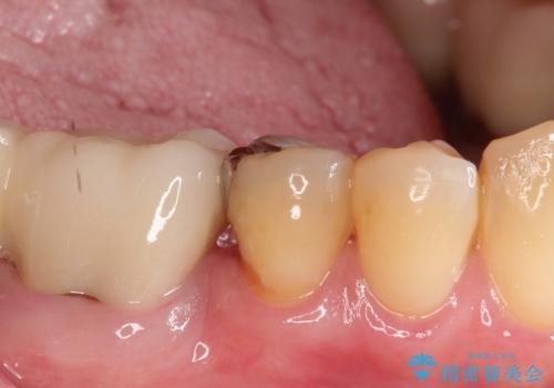 【PGAインレー】深い位置の二次カリエスの治療前