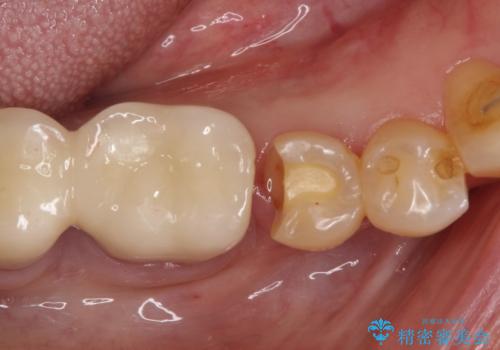 【PGAインレー】深い位置の二次カリエスの治療中