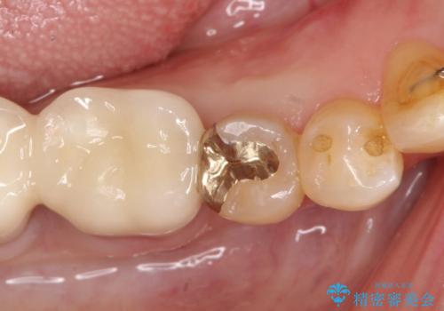 【PGAインレー】深い位置の二次カリエスの治療後