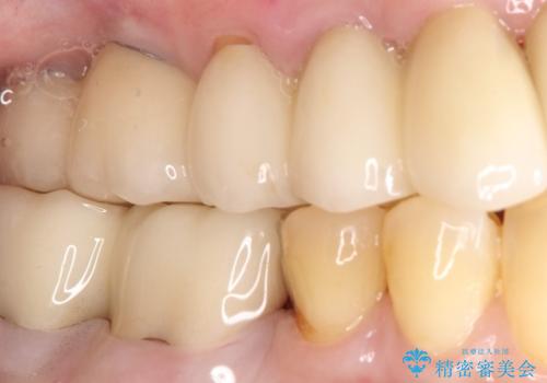 【PGAインレー】深い位置の二次カリエスの治療後