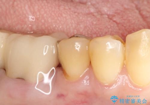 【PGAインレー】深い位置の二次カリエスの治療後