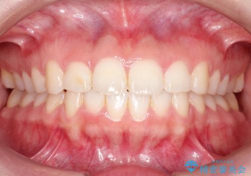 【インビザライン】前歯が出ているのを治したいの治療後