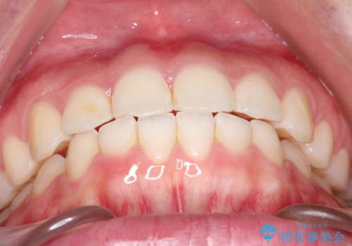 【インビザライン】前歯が出ているのを治したいの治療後