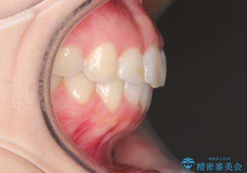 【インビザライン】前歯が出ているのを治したいの治療後
