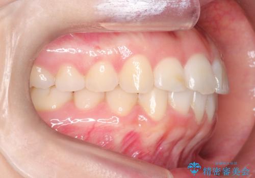 【インビザライン】前歯が出ているのを治したいの治療後