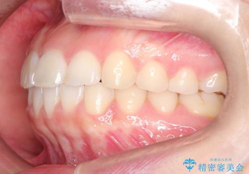 【インビザライン】前歯が出ているのを治したいの治療後