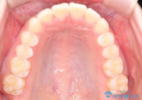 【インビザライン】前歯が出ているのを治したいの治療後