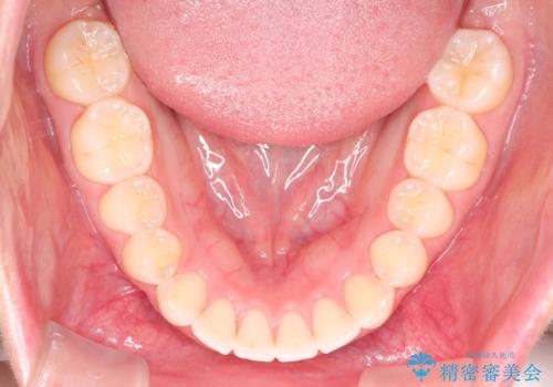 【インビザライン】前歯が出ているのを治したいの治療後
