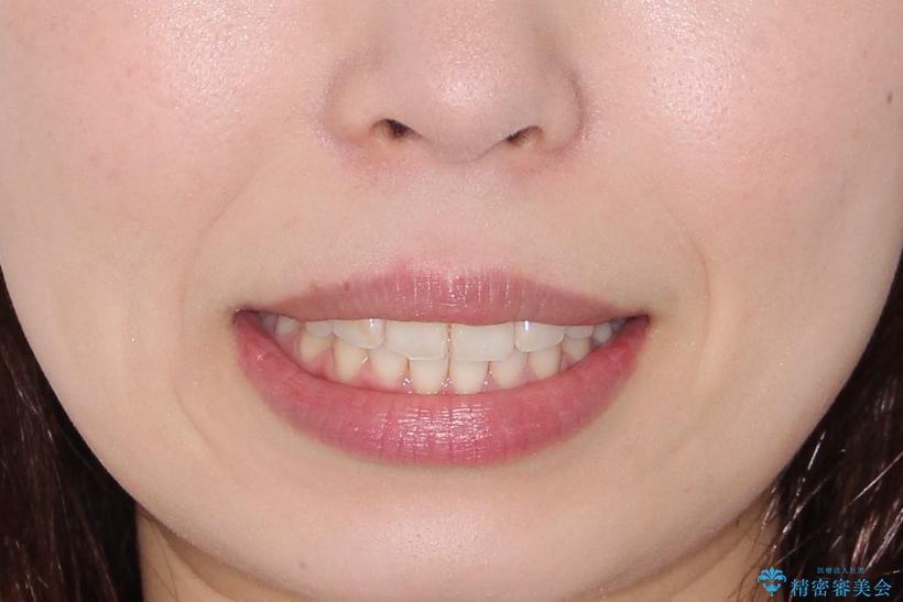 【インビザライン】前歯が出ているのを治したいの治療後(顔貌)