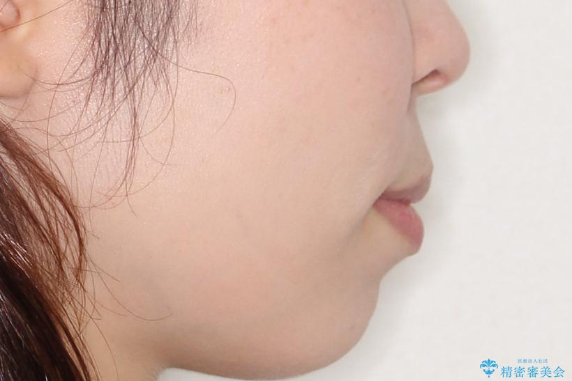 【インビザライン】前歯が出ているのを治したいの治療後(顔貌)