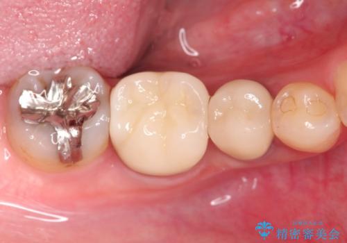 【外部吸収】根管治療、外科治療からのオールセラミッククラウンの治療後