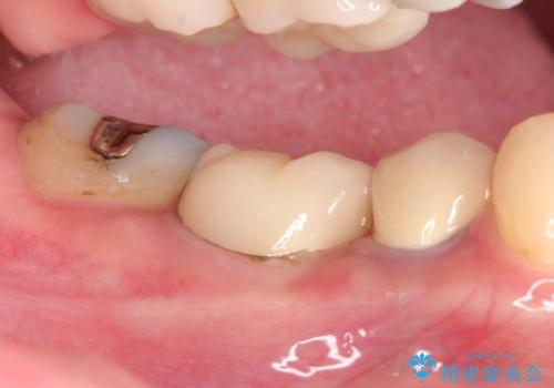 【外部吸収】根管治療、外科治療からのオールセラミッククラウンの治療後