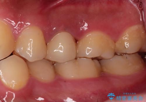根管治療〜オールセラミッククラウンの治療後