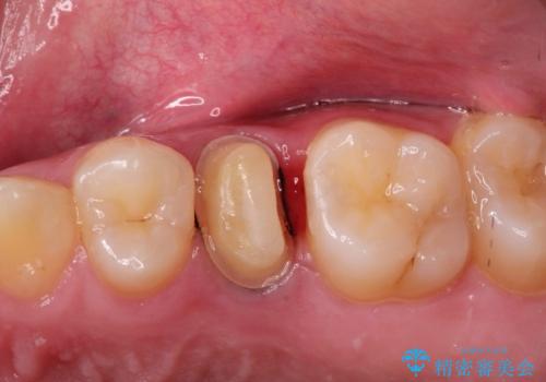 根管治療〜オールセラミッククラウンの治療中