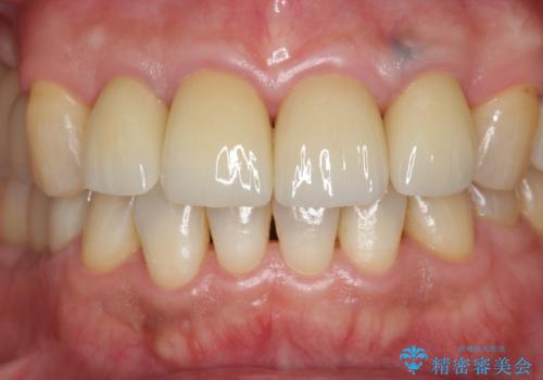 「 放置した虫歯 」 前歯セラミック治療 の治療後