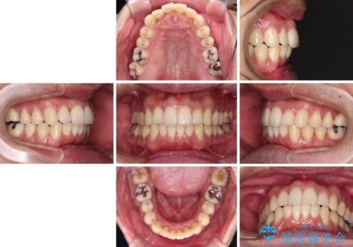 下顎骨が顕著に右側にずれている インビザラインによる咬合改善の治療後