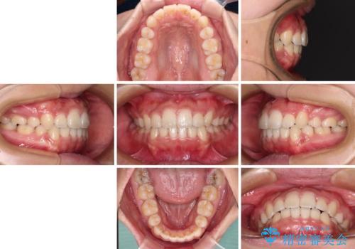 気になる八重歯を治したい 目立たないワイヤーでの抜歯矯正の治療後