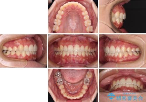 前歯のデコボコをインビザラインでスッキリとの治療後