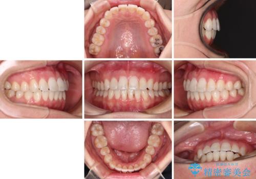 長年気にしていた前歯 インビザラインで目立たず改善の治療後